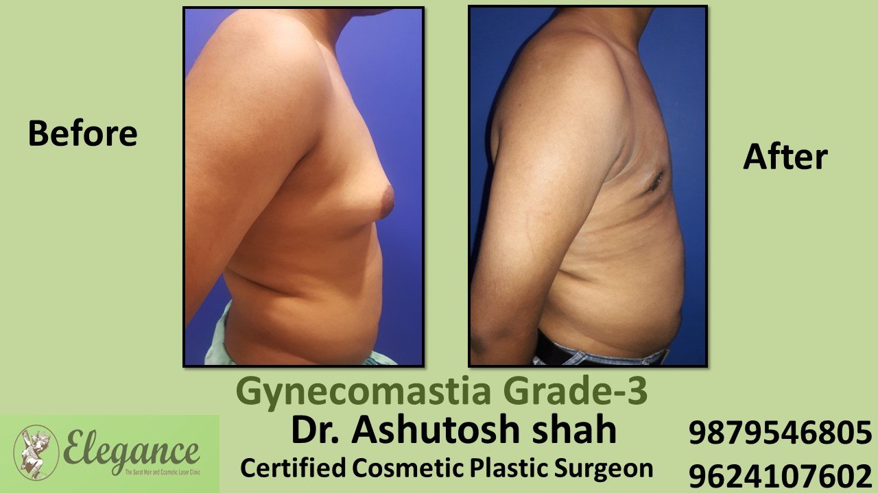 Slight Breast Roll, Gynecomastia Grade-3, Chikhli, Gujarat, India.