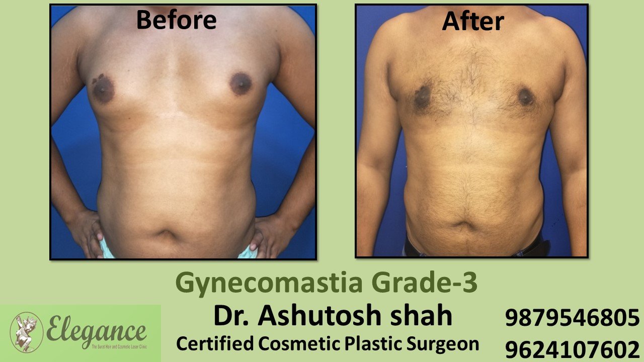 Slight Breast Roll, Gynecomastia Grade-3, Kamrej, Gujarat, India.