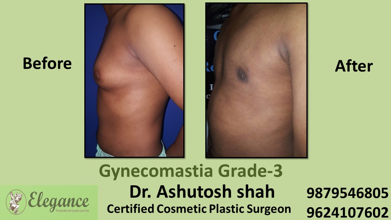 Slight Breast Roll, Gynecomastia Grade-3, Kim, Gujarat, India.