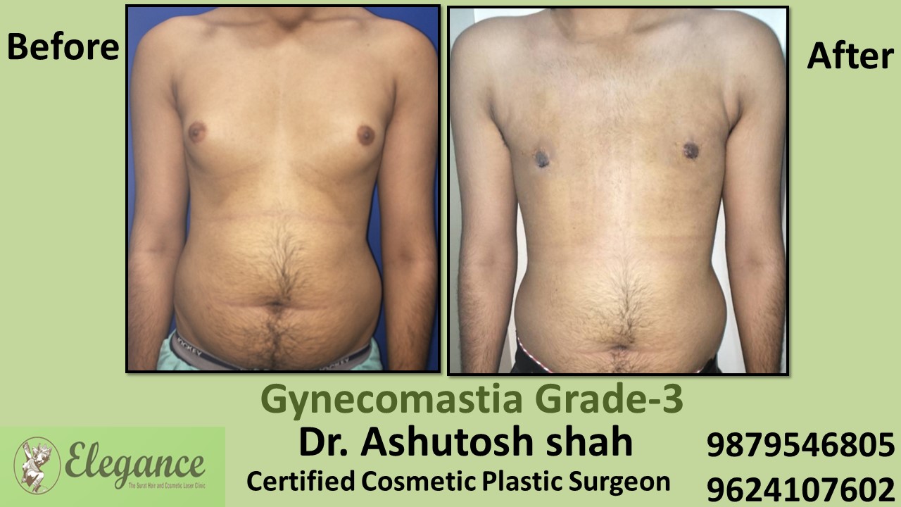Slight Breast Roll, Gynecomastia Grade-3, Kosmba, Gujarat, India.