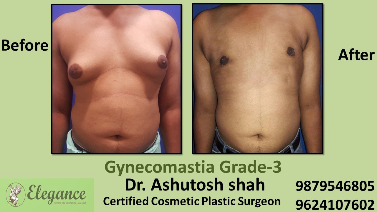 Slight Breast Roll, Gynecomastia Grade-3, Mangrol, Gujarat, India.