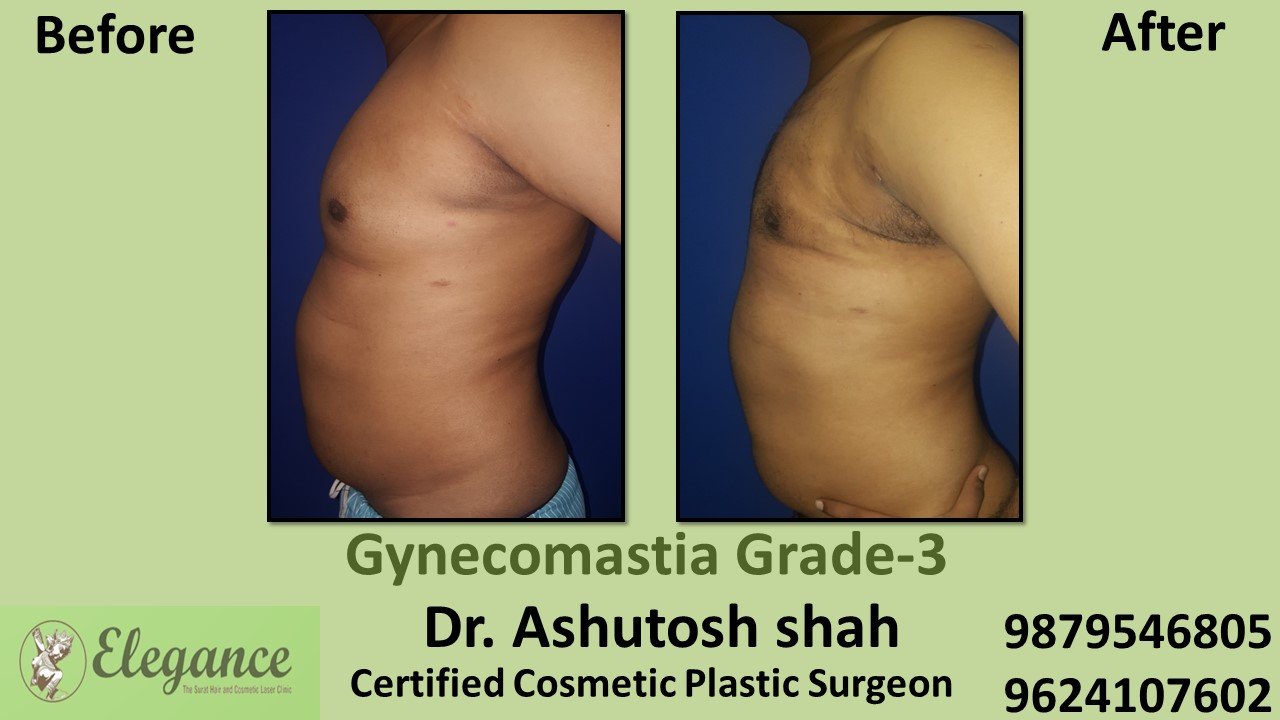 Slight Breast Roll, Gynecomastia Grade-3, Selvasa, Gujarat, India.