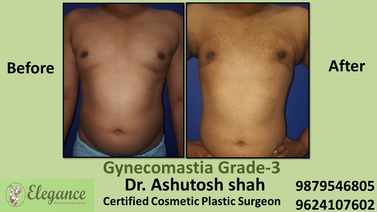 Slight Breast Roll, Gynecomastia Grade-3, Surat, Gujarat, India.