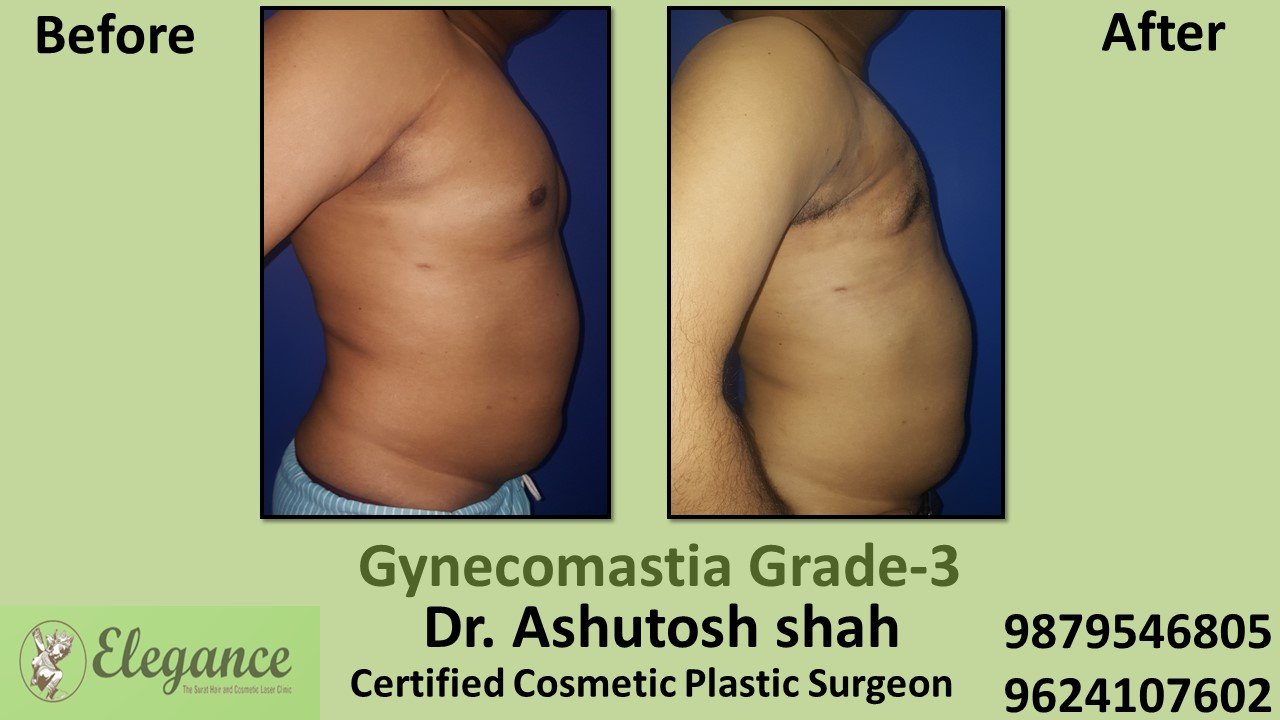 Slight Breast Roll, Gynecomastia Grade-3, Vadodara, Gujarat, India.