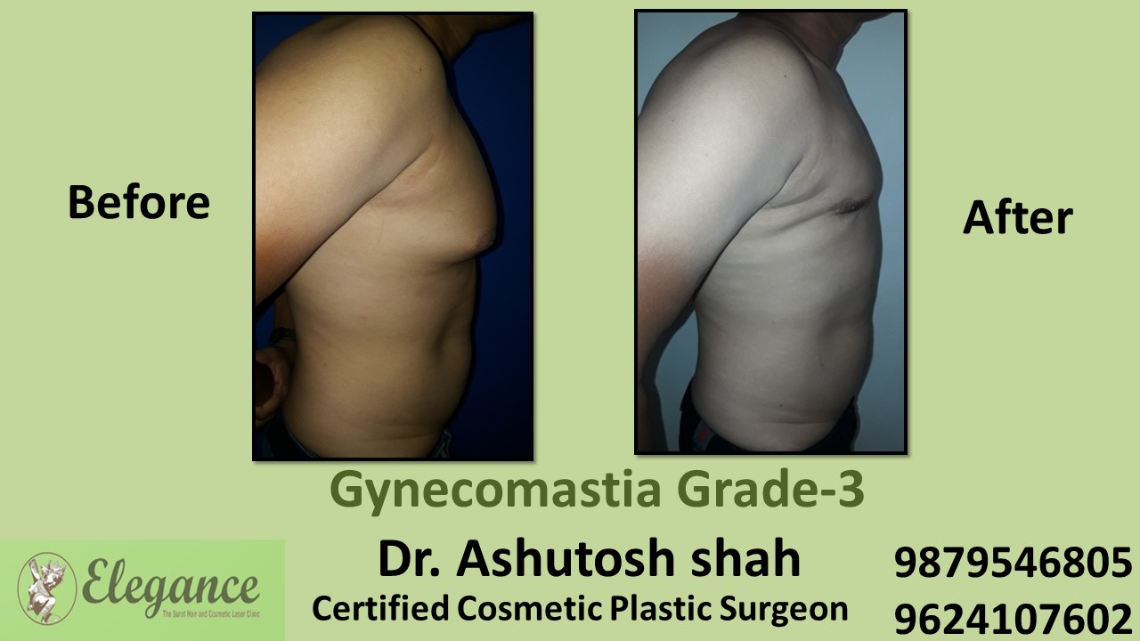Slight Breast Roll, Gynecomastia Grade-3, Vapi, Gujarat, India.