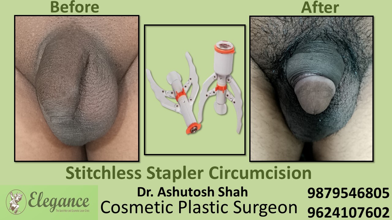Specialist for Stapler Circumcision in Adajan, Surat