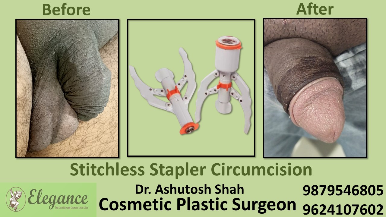 Specialist for Stapler Circumcision in Bardoli