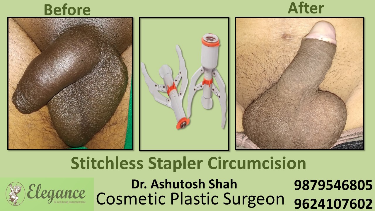 Specialist for Stapler Circumcision in Bharuch