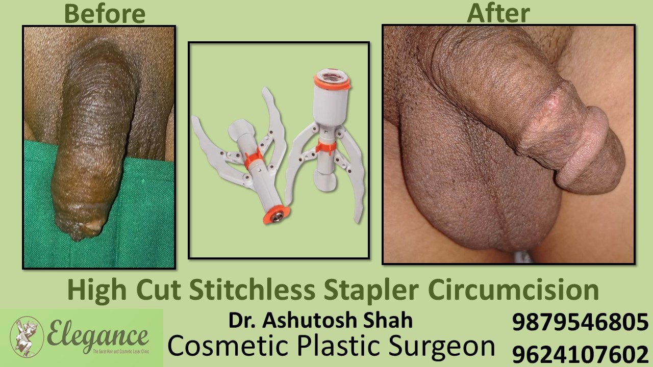 Specialist for Stapler Circumcision in Gujarat