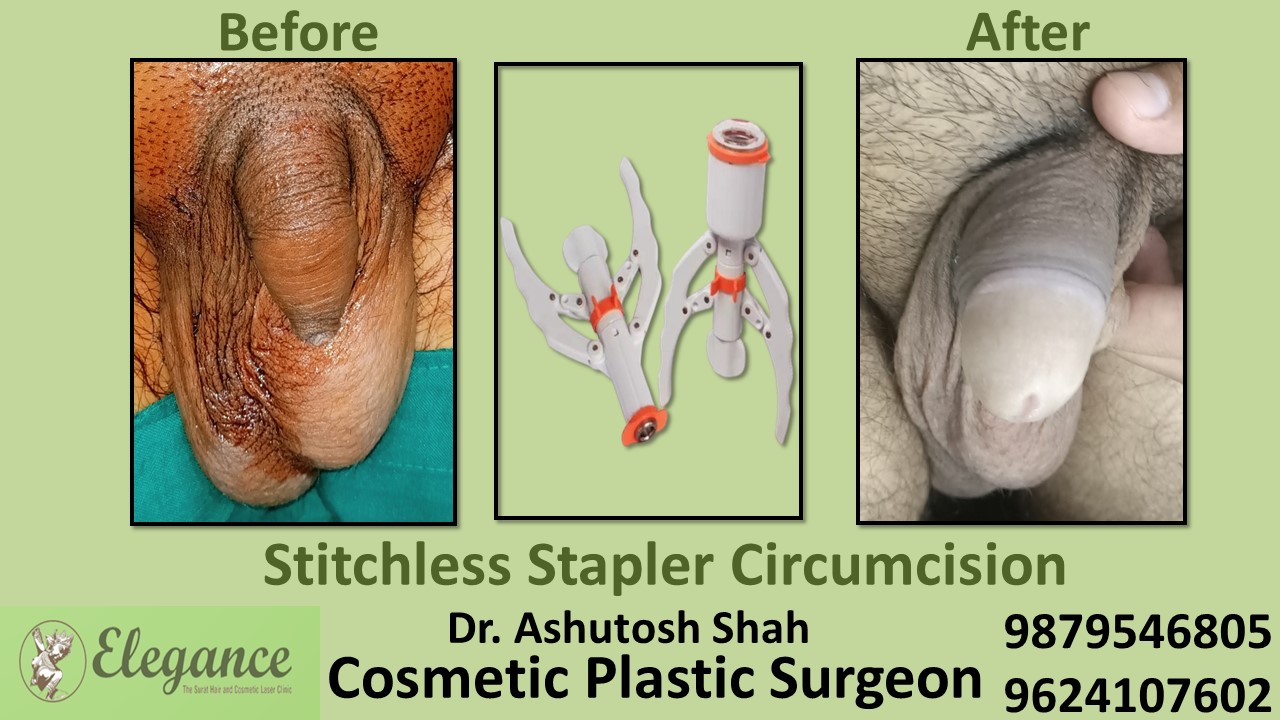 Specialist for Stapler Circumcision in Mumbai