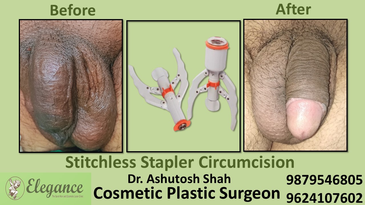 Specialist for Stapler Circumcision in Navsari