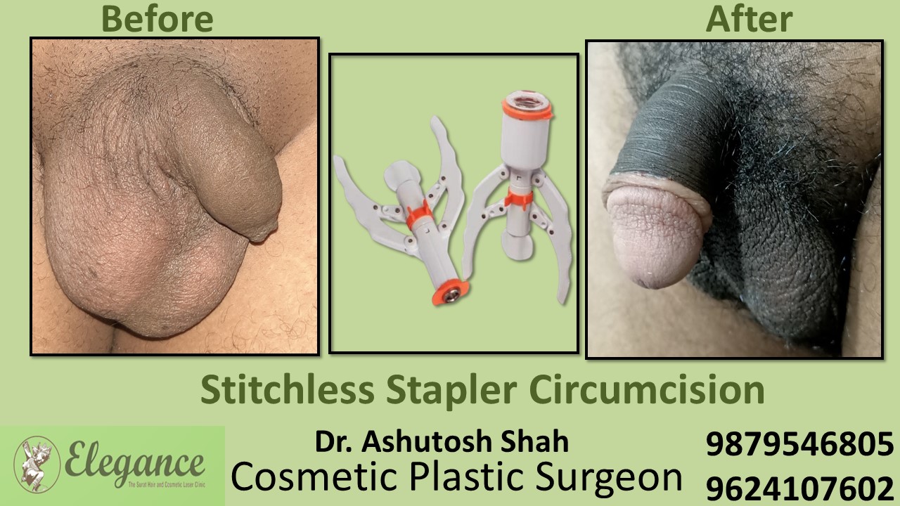 Specialist for Stapler Circumcision in Valsad