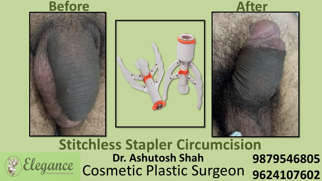 Specialist for Stapler Circumcision in Vapi