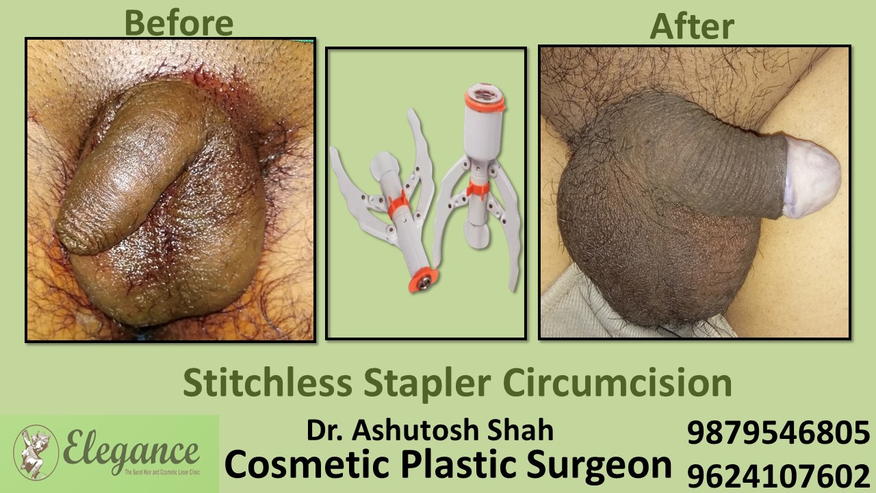 Specialist for Stapler Circumcision in Vesu, Surat