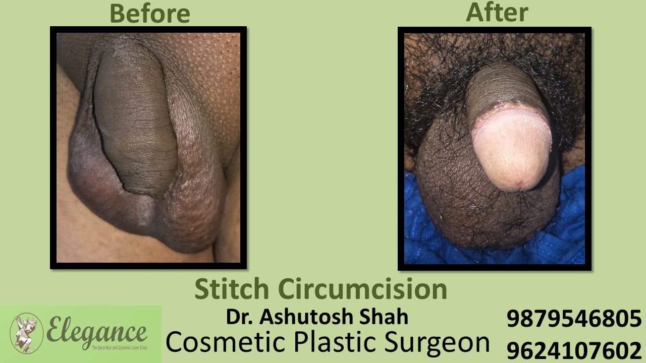 Specialist for Stitch Circumcision in Adajan
