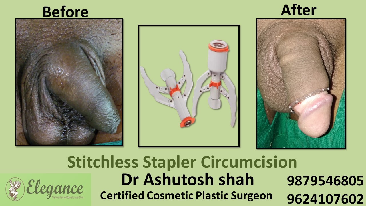 Specialist for Stitchless Stapler Circumcision in Ankleshwar