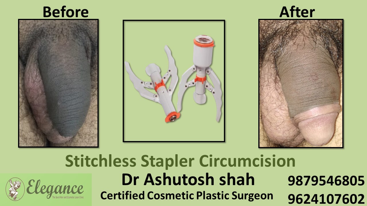 Specialist for Stitchless Stapler Circumcision in Baroda