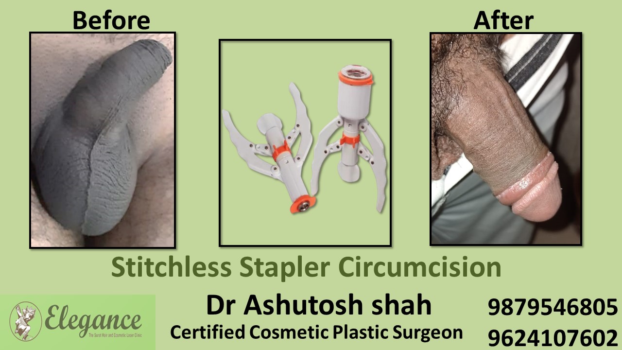 Specialist for Stitchless Stapler Circumcision in Bharuch