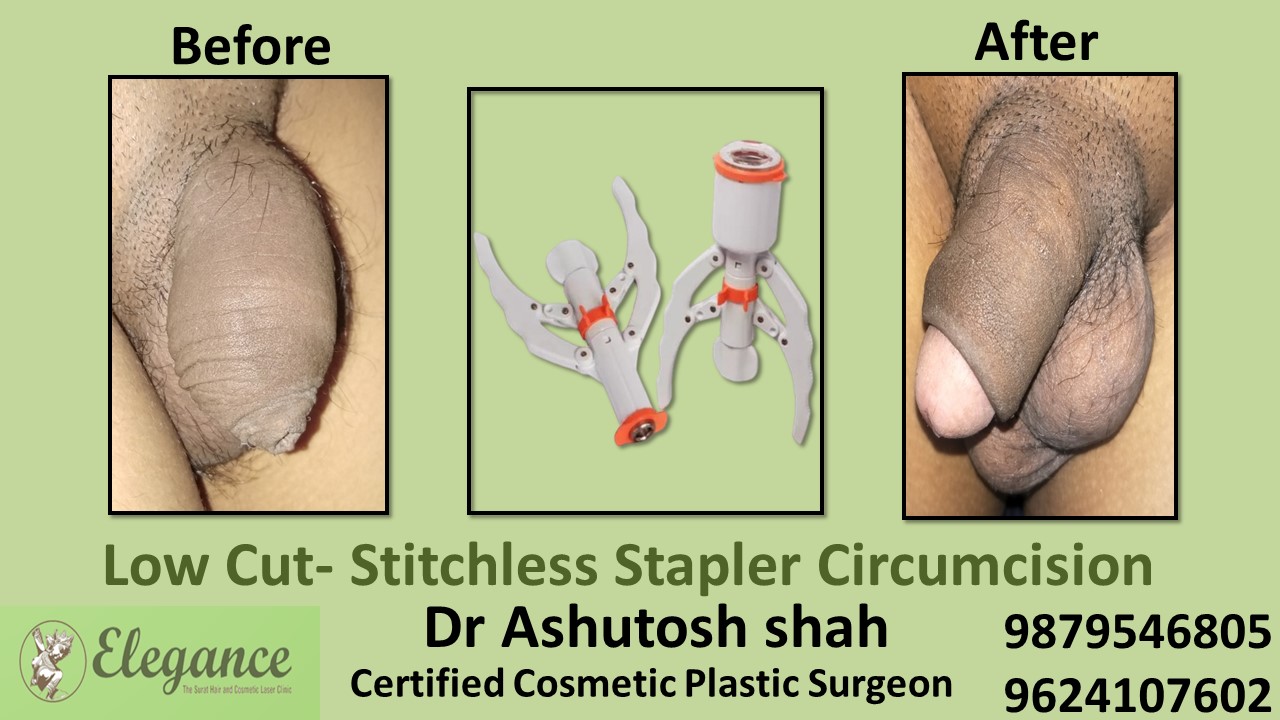 Specialist for Stitchless Stapler Circumcision in Chhota Udaipur