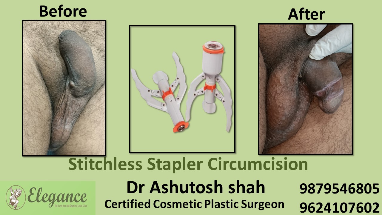 Specialist for Stitchless Stapler Circumcision in Vapi