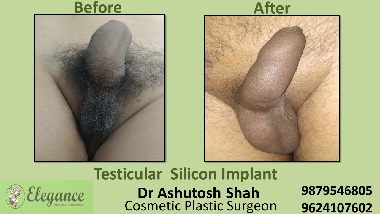 Testicular Implant Surgery in Surat, Gujarat (India)