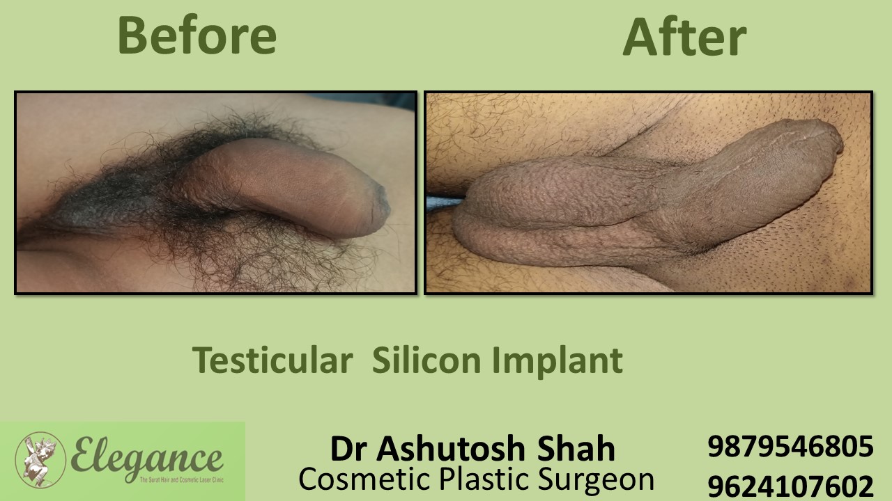 Specialist for Testicular Silicon Implant in Surat