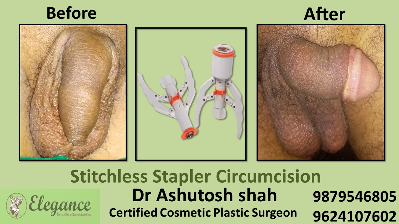 Stapler Circumcision in Ahmadabad, Gujarat