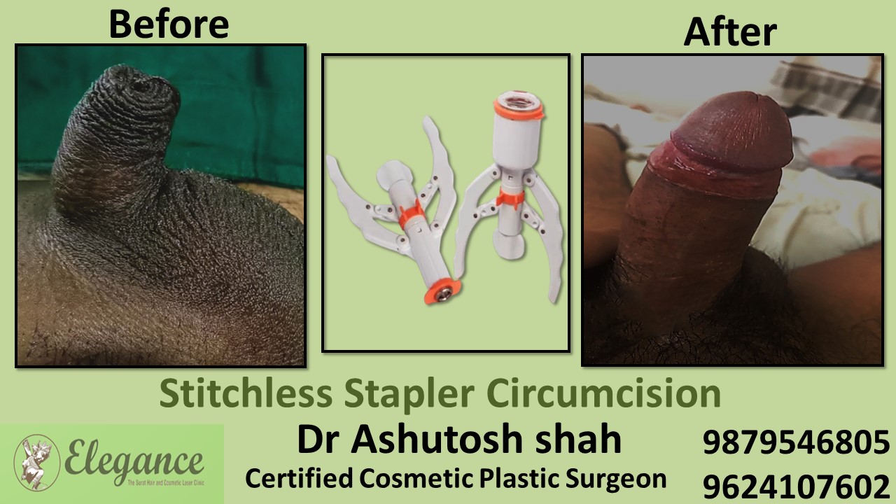 Stapler Circumcision in Ahmadabad, Gujarat