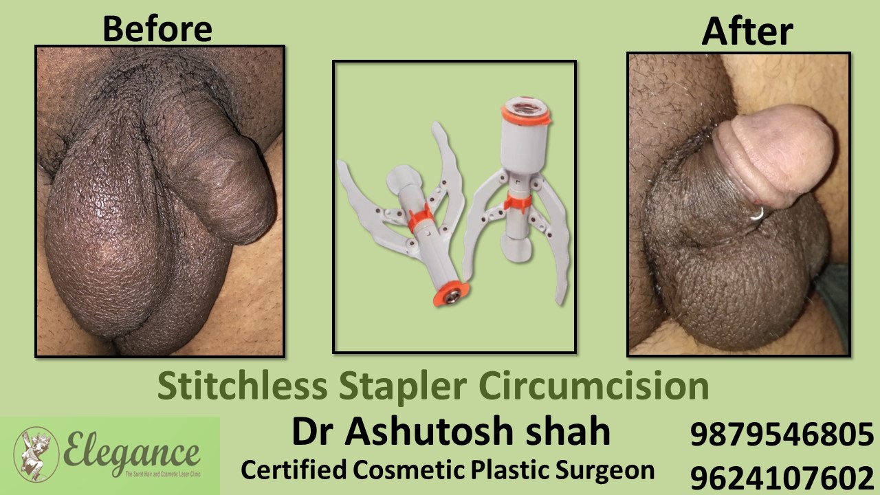 Stapler Circumcision in Anand
