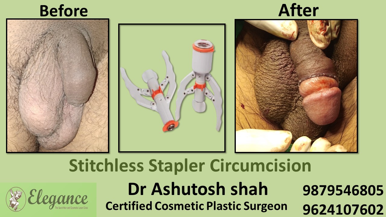Stapler Circumcision in Ankleshwar, Gujarat