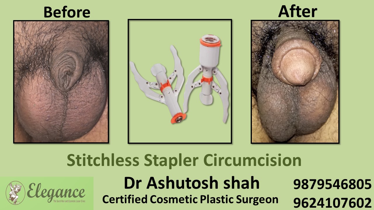 Stapler Circumcision in Bardoli, Gujarat