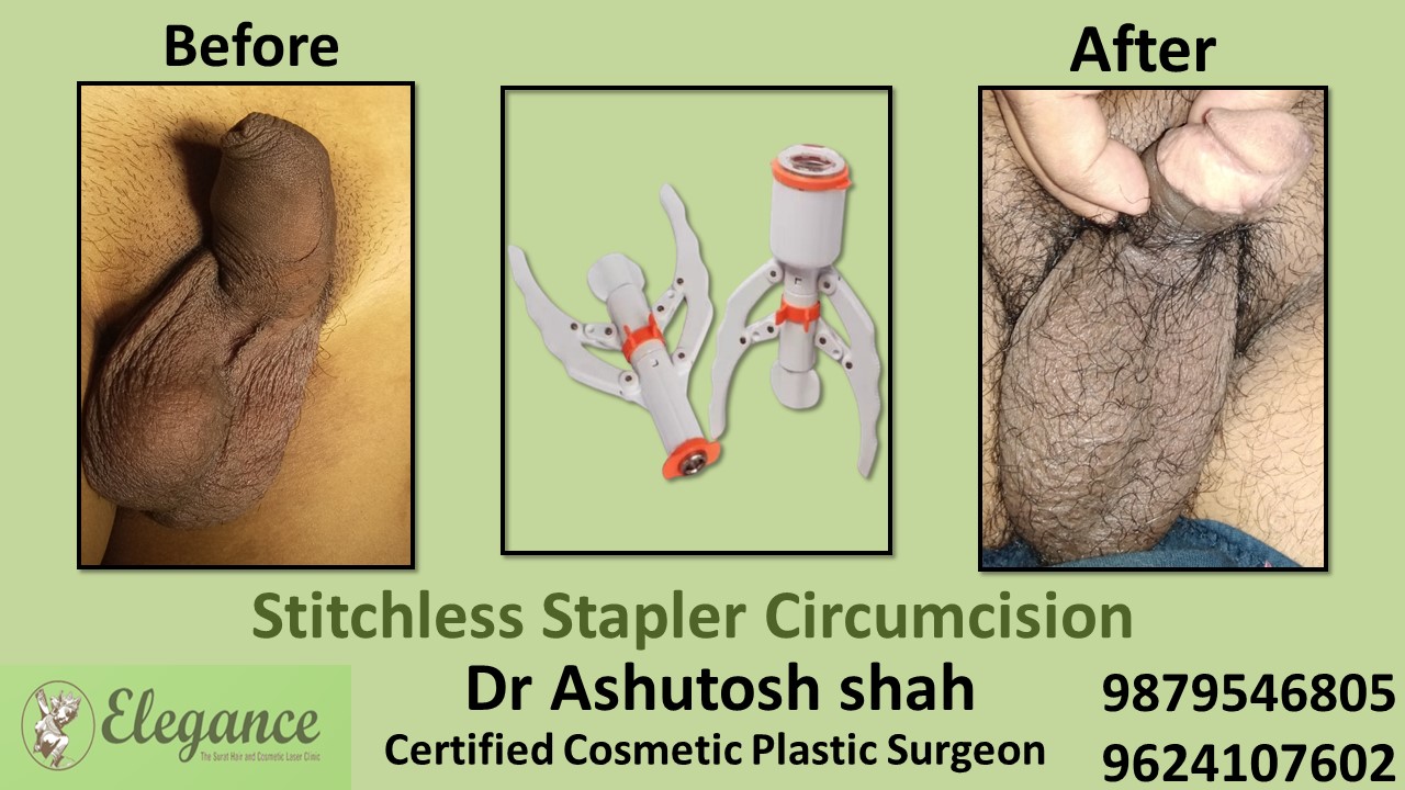 Stapler Circumcision in Bhuj, Gujarat