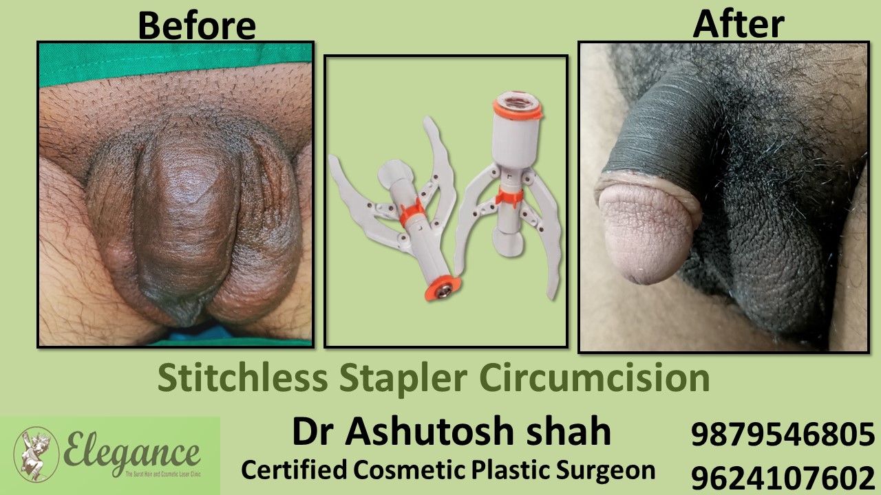 Stapler Circumcision in Gujarat