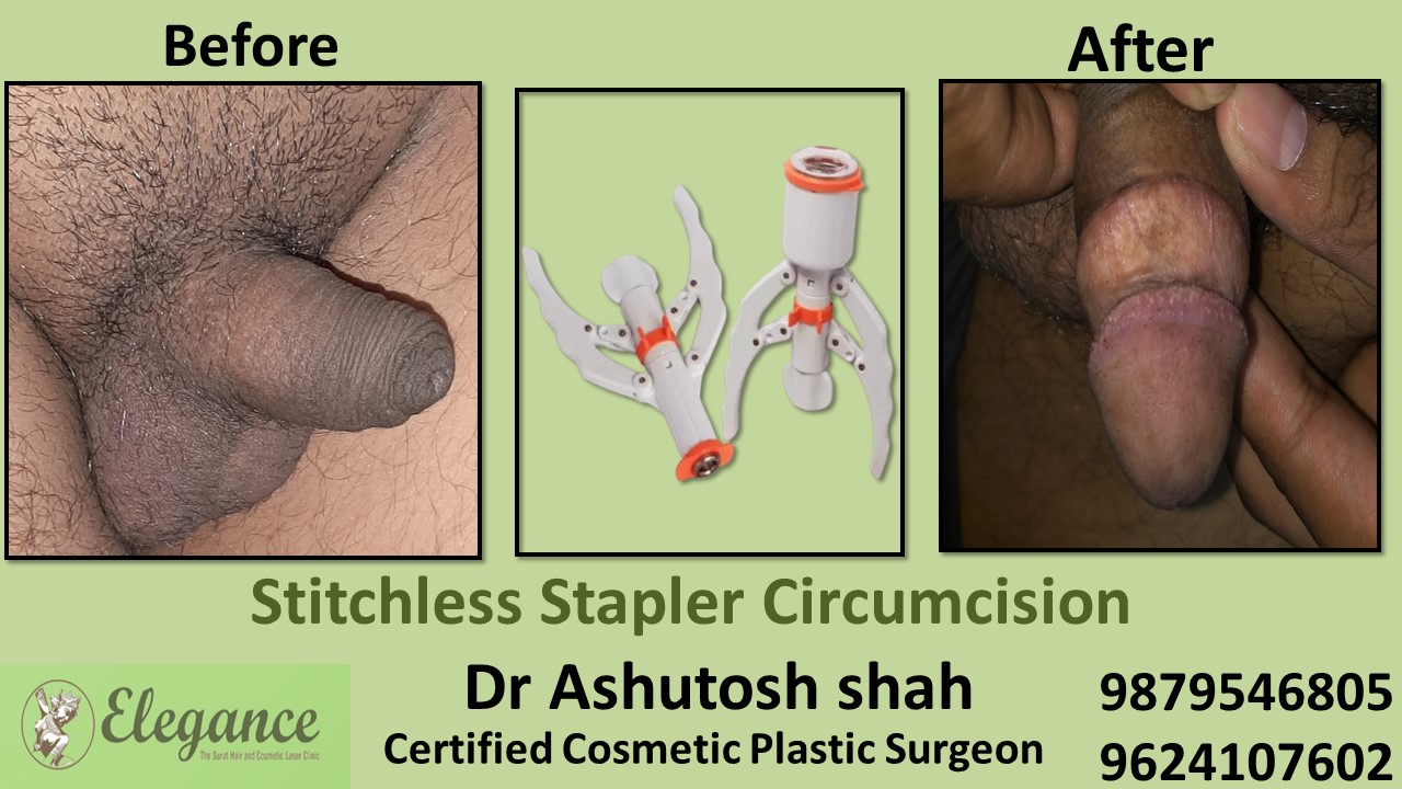 Stapler Circumcision in Pune