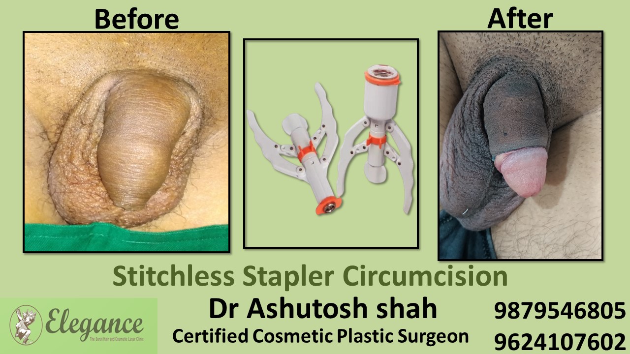 Stapler Circumcision in Surat
