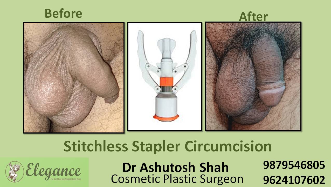 Stapler Circumcision Surgery, Ankleshwar, Gujarat, India