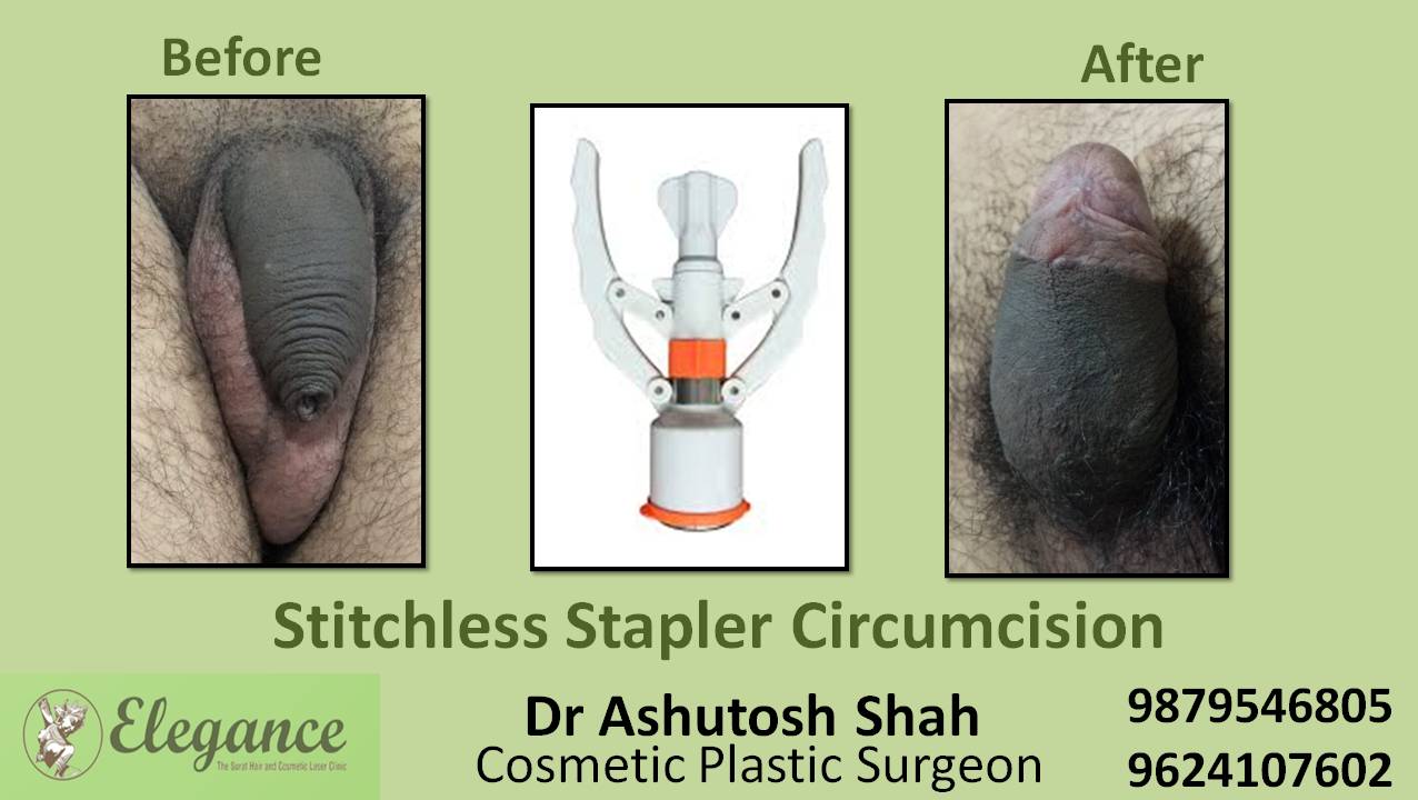 Stapler Circumcision Surgery, Ankleshwar, Gujarat.
