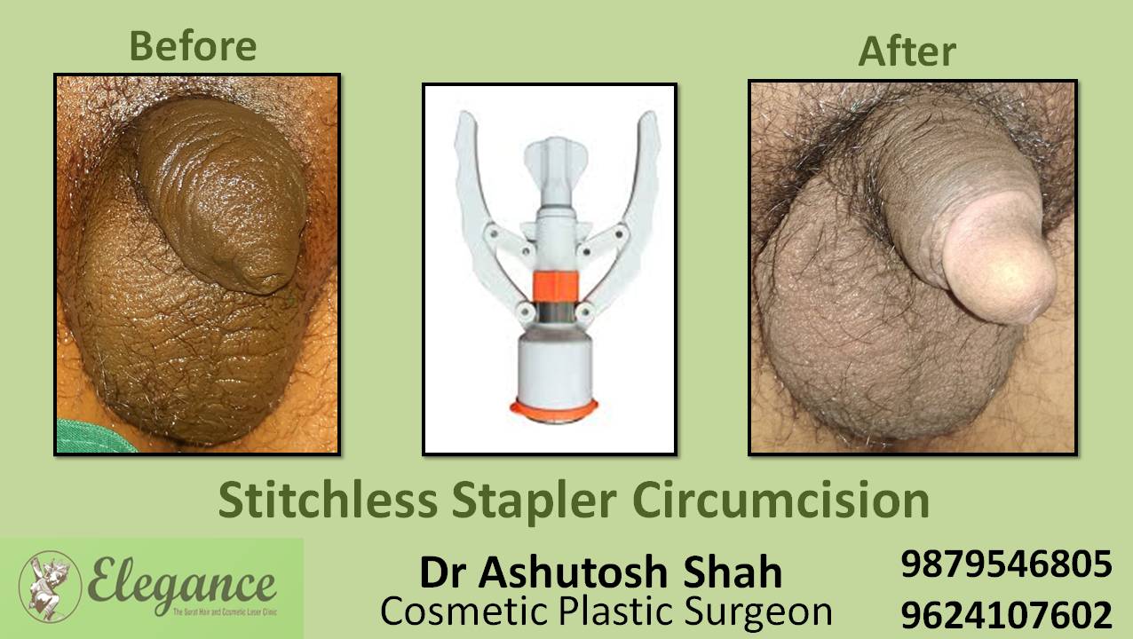 Stapler Circumcision Surgery, Bardoli, Gujarat, India