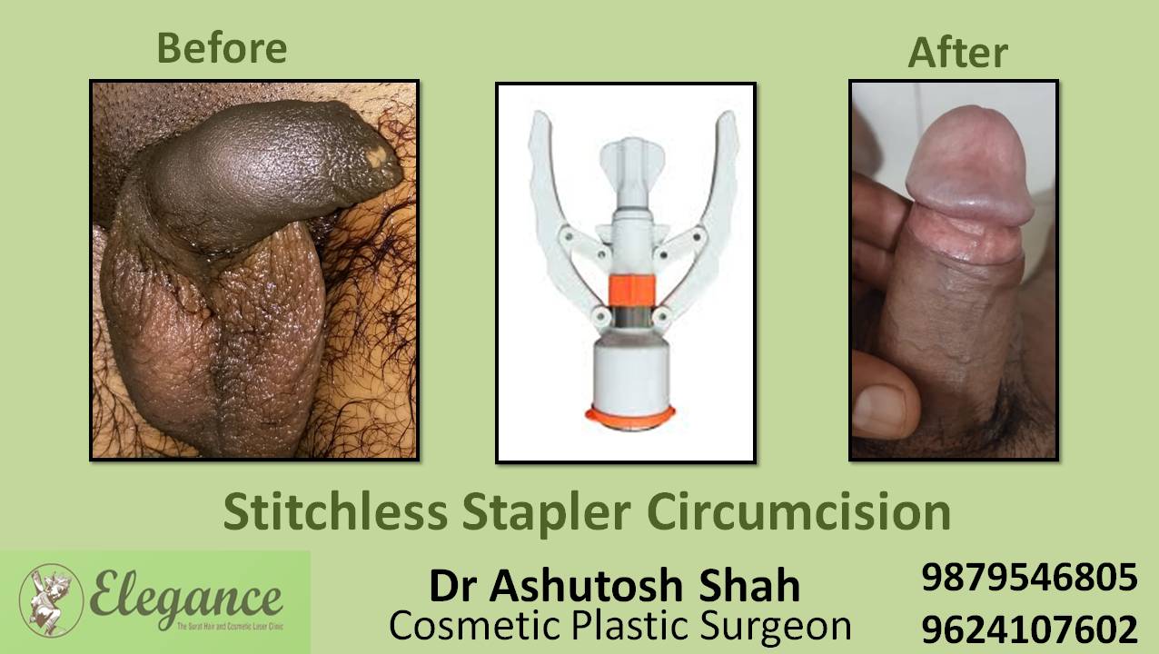 Stapler Circumcision Surgery, Bardoli, Gujarat.