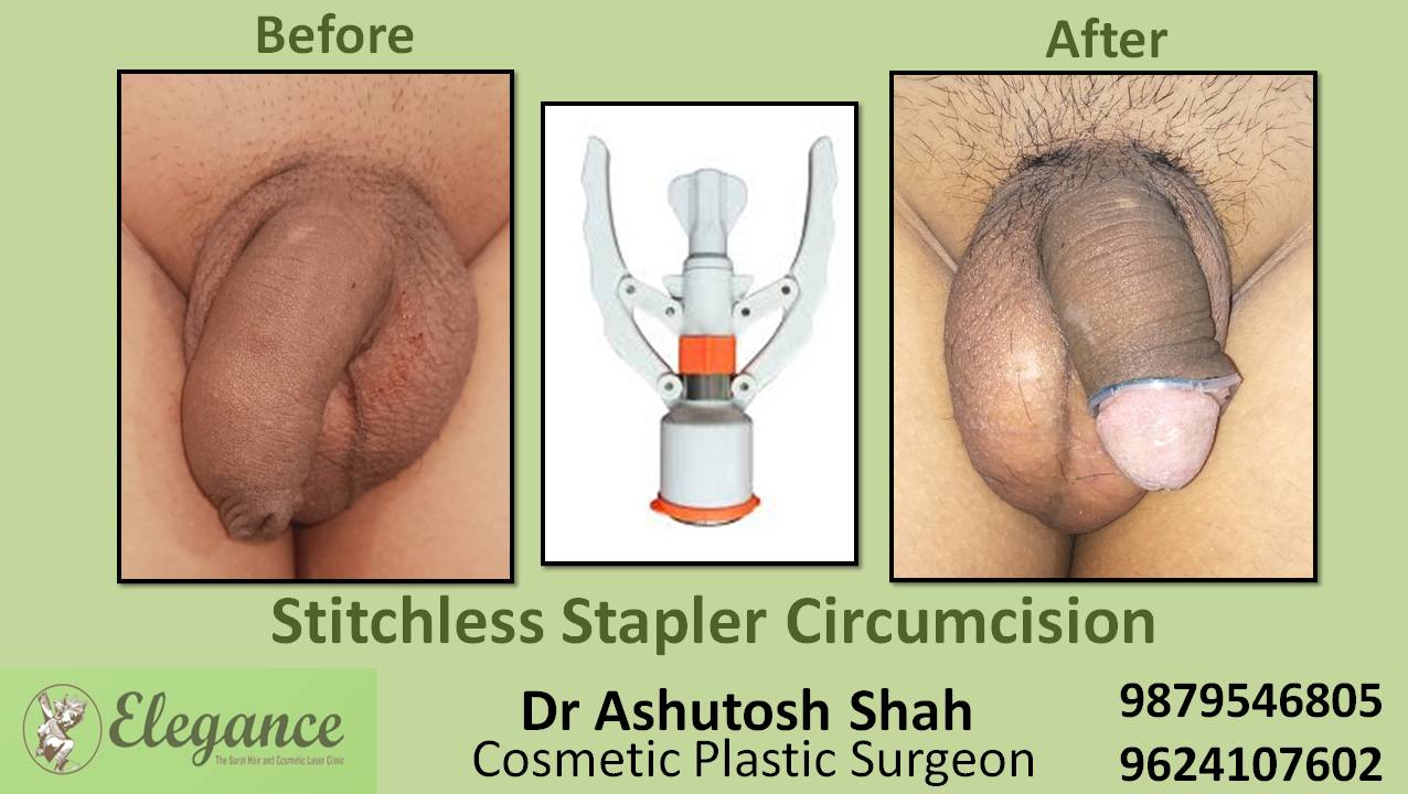 Stapler Circumcision Surgery, Bharuch, Gujarat, India