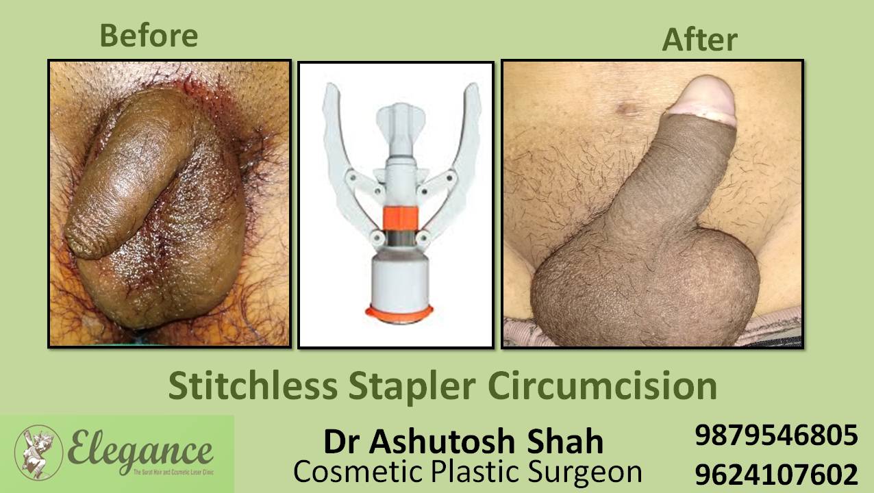 Stapler Circumcision Surgery, Bharuch, Gujarat.