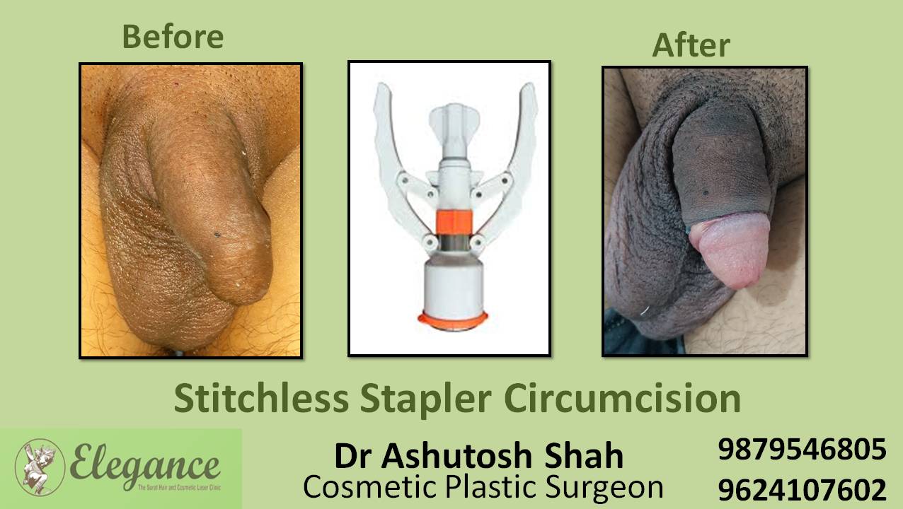 Stapler Circumcision Surgery, Bilimora, Gujarat, India