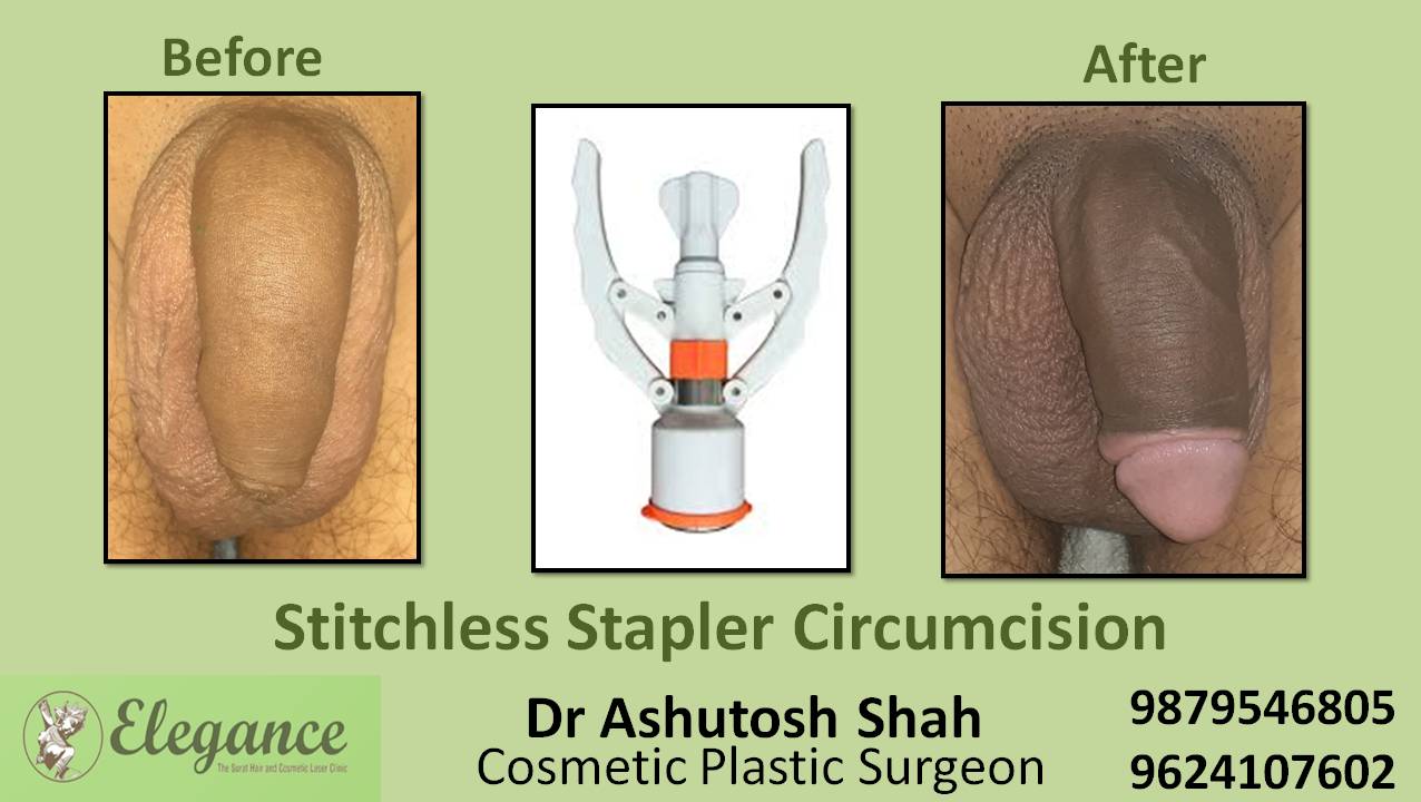 Stapler Circumcision Surgery, Bilimora, Gujarat.