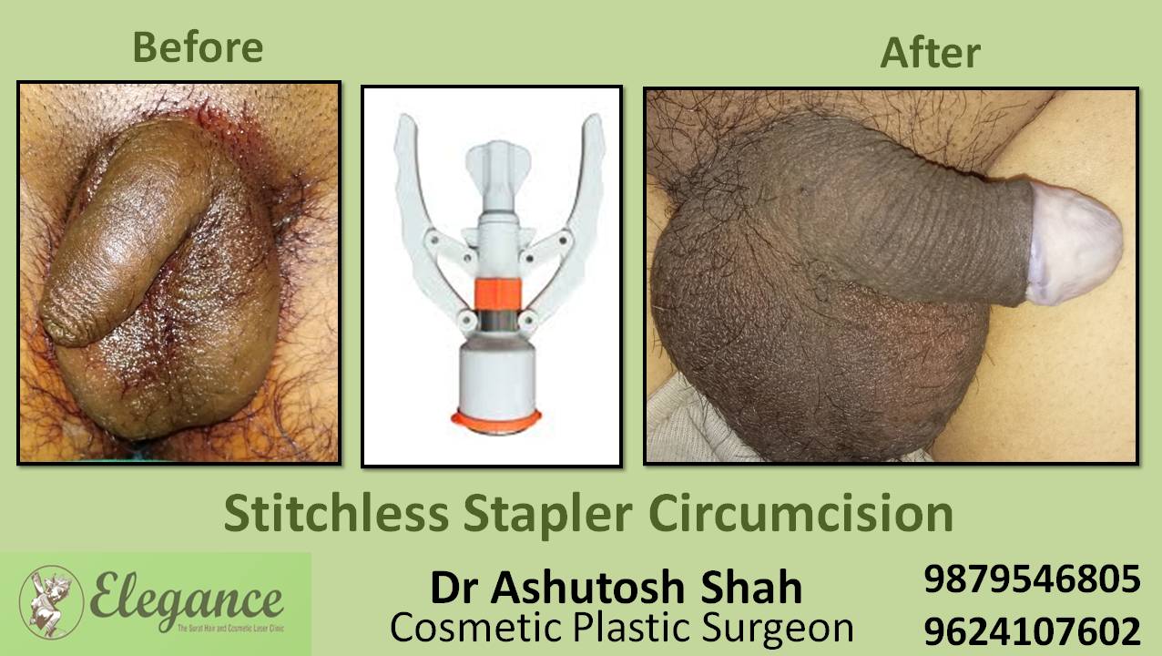 Stapler Circumcision Surgery, Chikhli, Gujarat, India