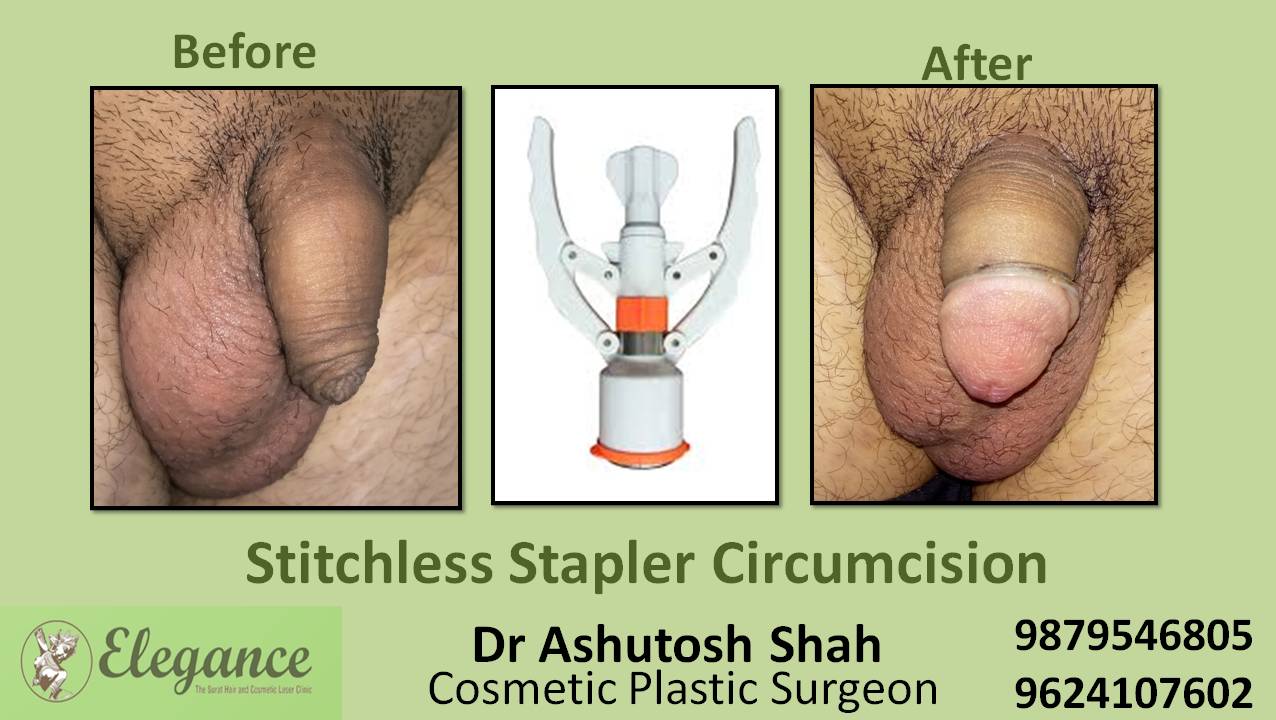 Stapler Circumcision Surgery, Daman, Gujarat, India
