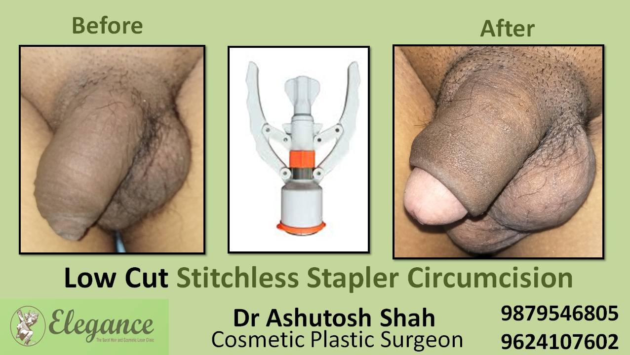 Stapler Circumcision Surgery, Daman, Gujarat.