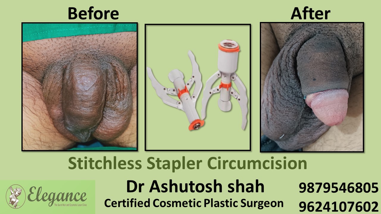 Stapler Circumcision Surgery in Adajan, Surat