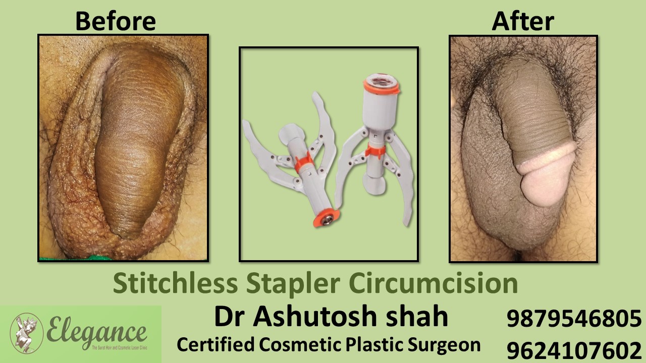 Stapler Circumcision Surgery in Anand