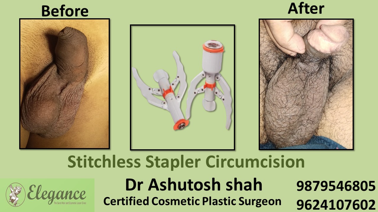 Stapler Circumcision Surgery in Bardoli