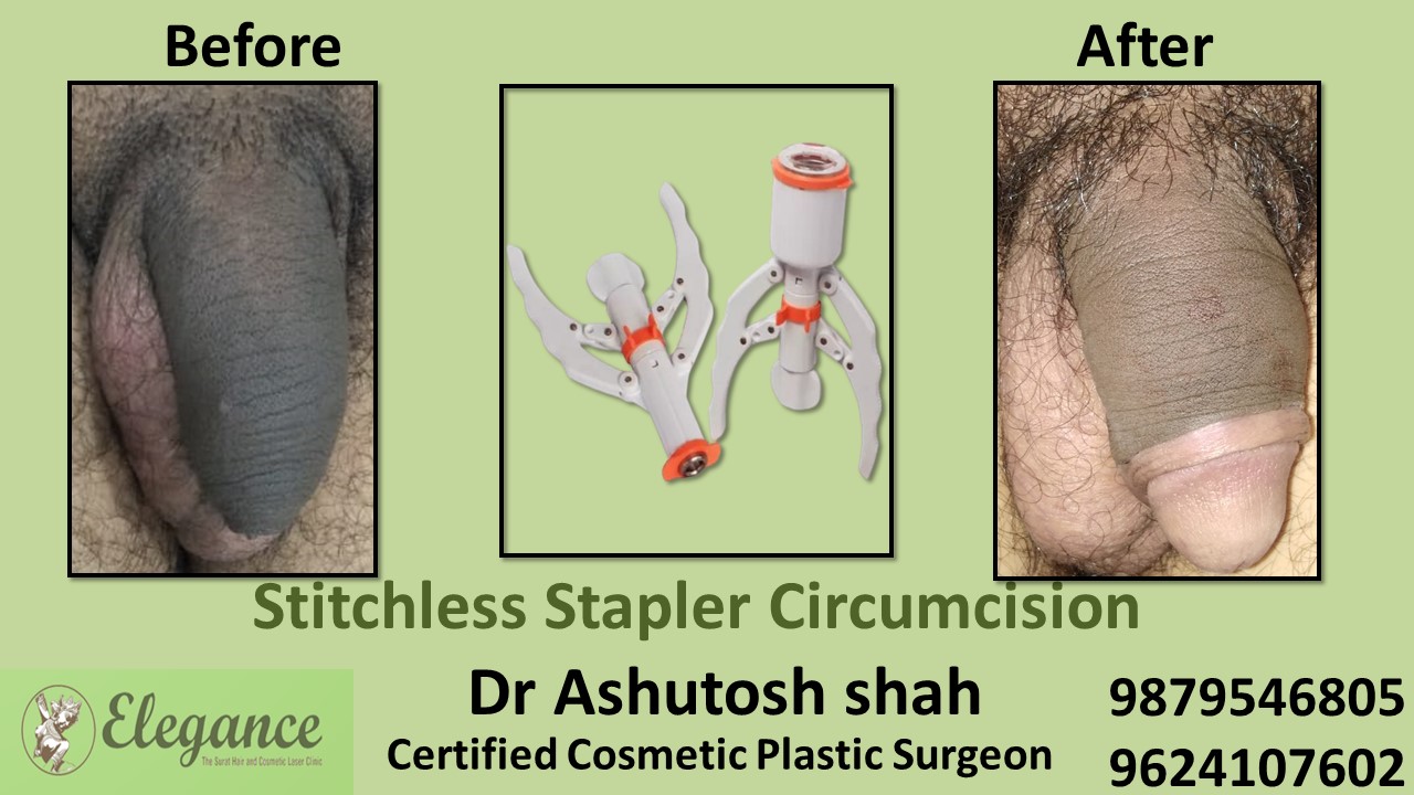Stapler Circumcision Surgery in Baroda